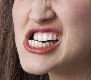 What Is Teeth Grinding (Bruxism)?